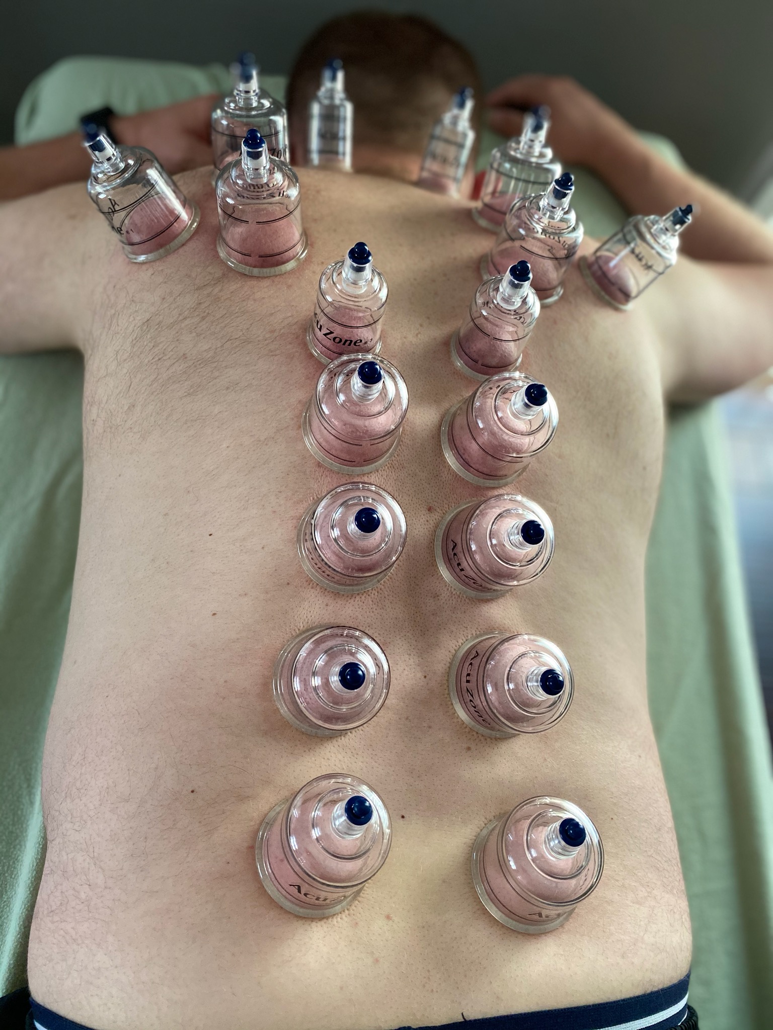 Vacuum (Cupping) Therapy